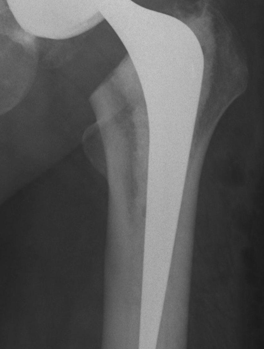 THR Type 3 Cemented Femur